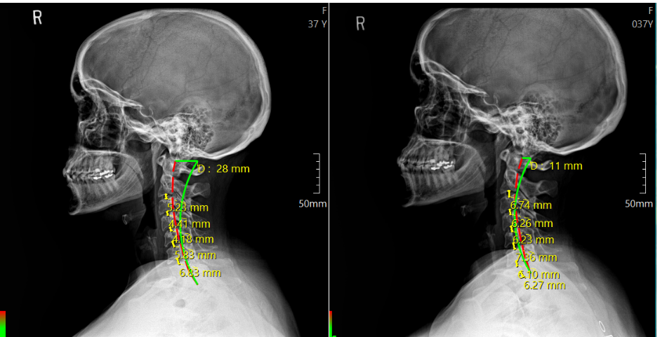 chiropractic xray